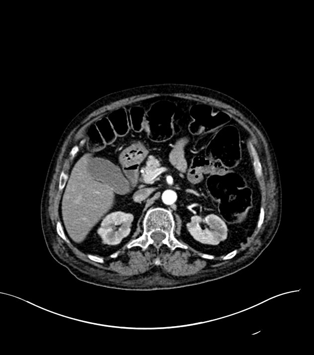 Cholangiocarcinoma with cerebral metastases (Radiopaedia 83519-98629 B 33).jpg