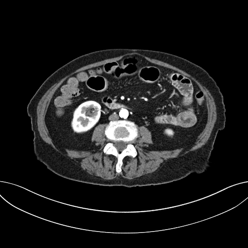 Cholecystoduodenal fistula due to calculous cholecystitis with gallstone migration (Radiopaedia 86875-103077 A 40).jpg