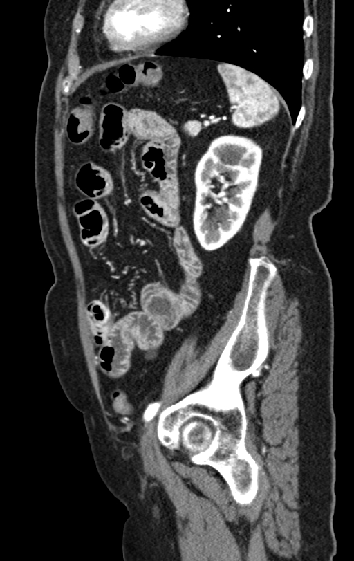 Cholecystoduodenal fistula due to calculous cholecystitis with gallstone migration (Radiopaedia 86875-103077 C 17).jpg