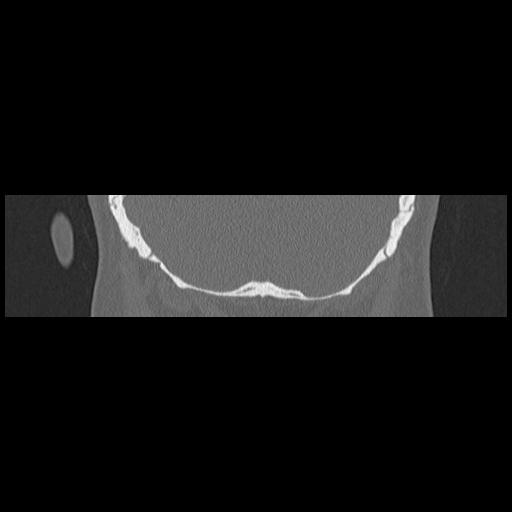 Cholesteatoma (Radiopaedia 84946-100455 Coronal bone window 133).jpg