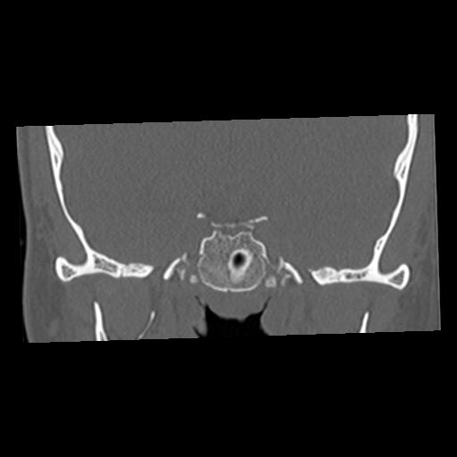 File:Cholesteatoma (Radiopaedia 84960-100474 Coronal bone window 13).jpg