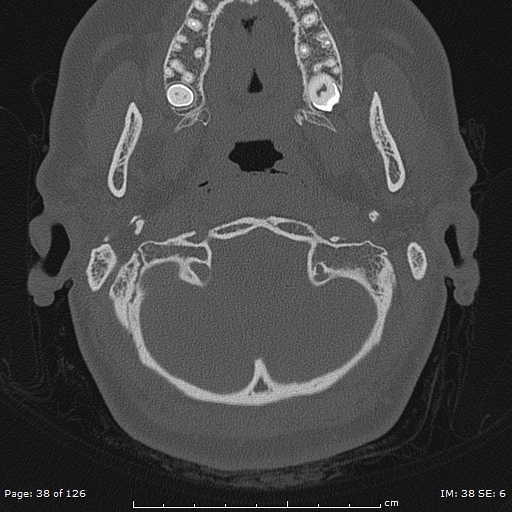 Cholesteatoma - external auditory canal (Radiopaedia 88452-105096 Axial bone window 1).jpg