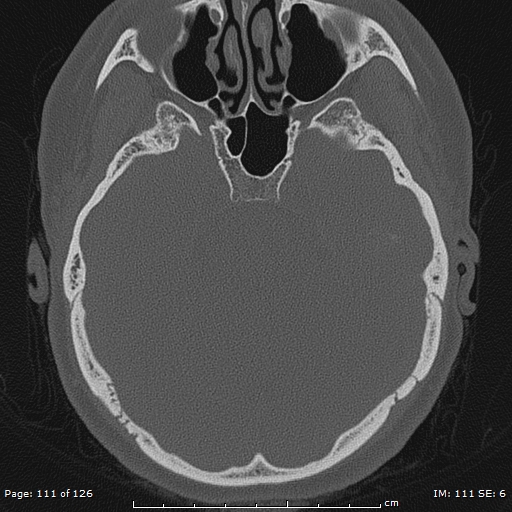 Cholesteatoma - external auditory canal (Radiopaedia 88452-105096 Axial bone window 74).jpg