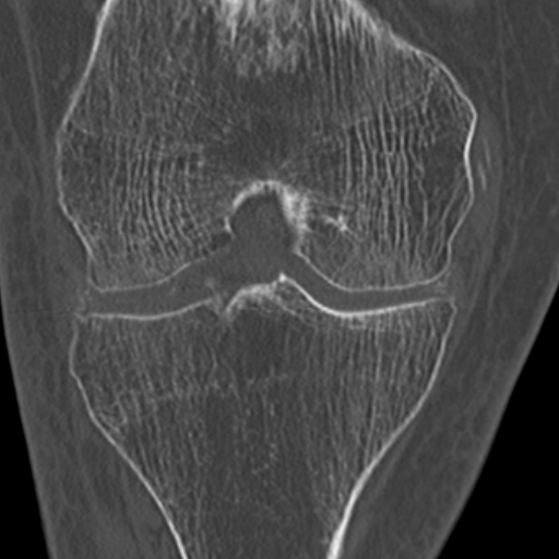 Chondrocalcinosis (Radiopaedia 16275-15955 Coronal bone window 30).jpg