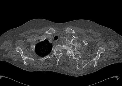File:Chondrosarcoma - chest wall (Radiopaedia 65192-74199 Axial bone window 21).jpg