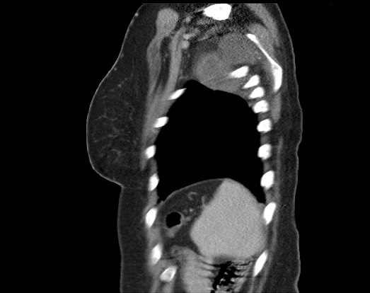 Chondrosarcoma - chest wall (Radiopaedia 65192-74199 B 11).jpg