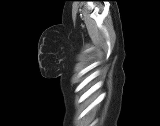File:Chondrosarcoma - chest wall (Radiopaedia 65192-74199 B 55).jpg