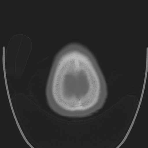 Chondrosarcoma of skull base- grade II (Radiopaedia 40948-43653 Axial bone window 48).png