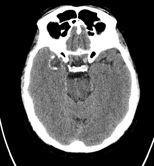 File:Chondrosarcoma of skull base- grade II (Radiopaedia 40948-43653 Axial non-contrast 11).png