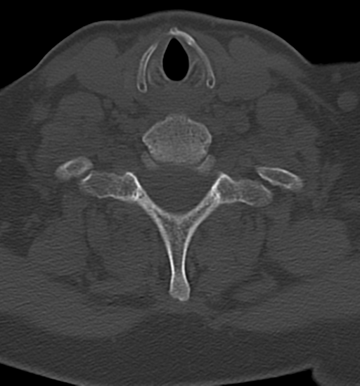 File:Chordoma (C4 vertebra) (Radiopaedia 47561-52188 Axial bone window 39).png