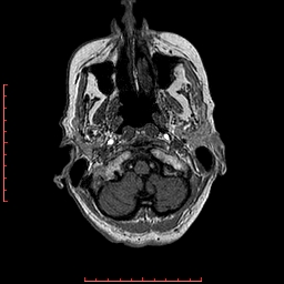 Choroid plexus xanthogranuloma (Radiopaedia 67843-77270 Axial T1 146).jpg