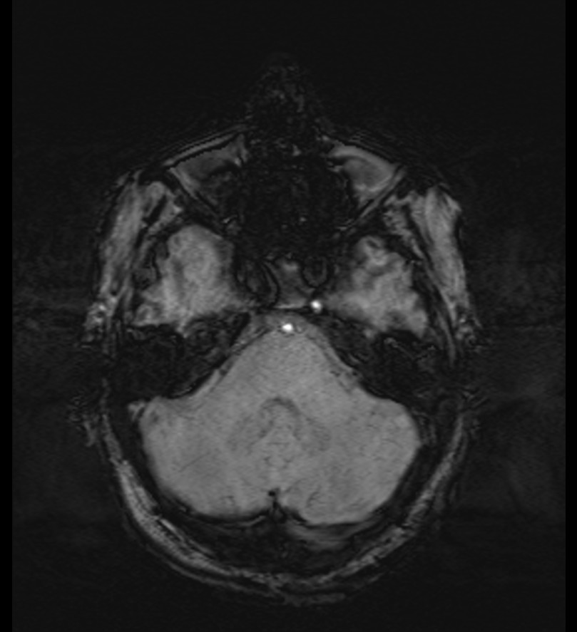 Choroid plexus xanthogranuloma (Radiopaedia 91271-108875 Axial SWI 17).jpg