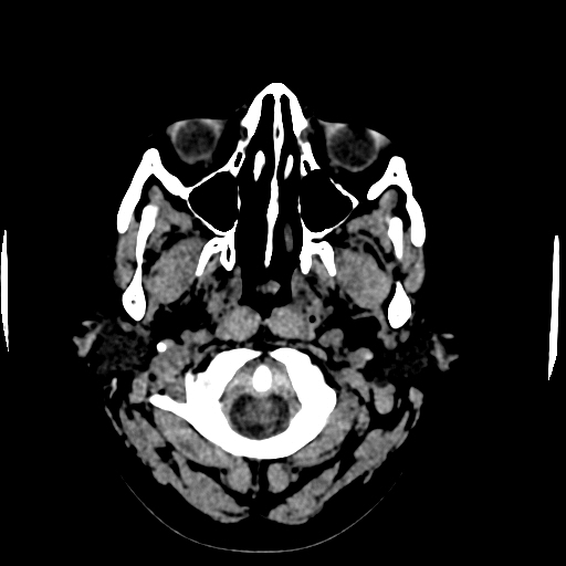 Choroid plexus xanthogranulomas (Radiopaedia 51621-57408 Axial non-contrast 1).jpg