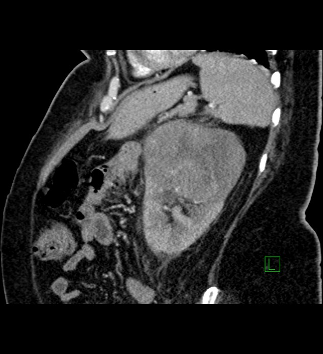 Chromophobe renal cell carcinoma (Radiopaedia 84239-99519 D 33).jpg