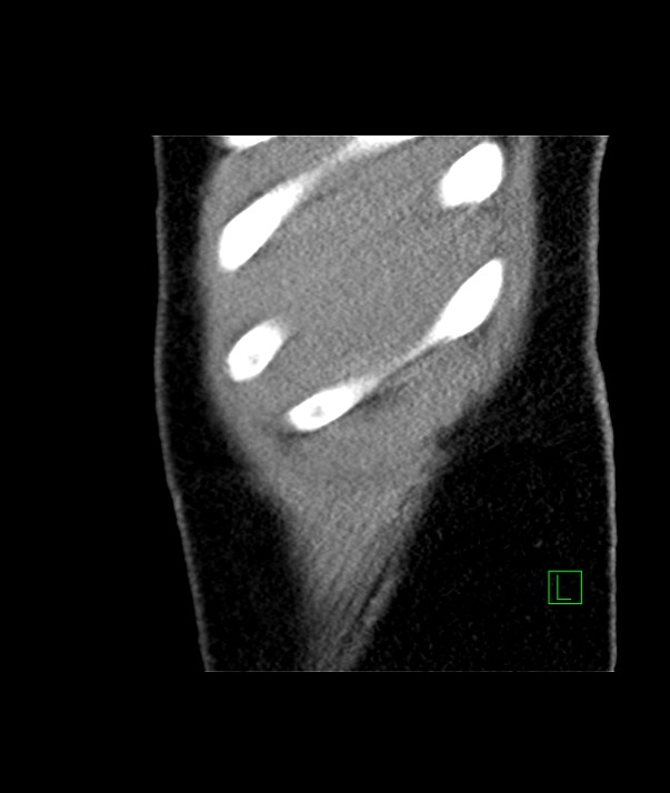 Chromophobe renal cell carcinoma (Radiopaedia 84255-99542 E 58).jpg
