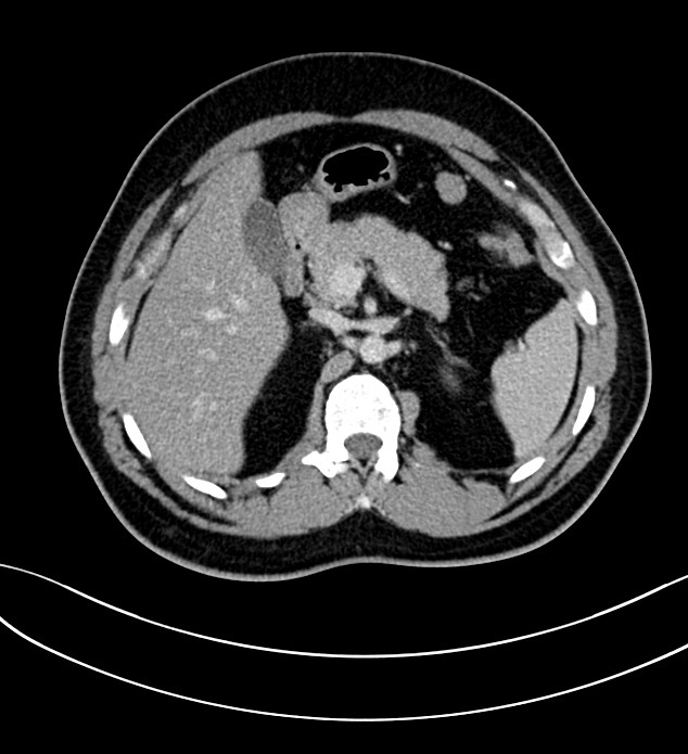 Chromophobe renal cell carcinoma (Radiopaedia 84286-99573 G 21).jpg