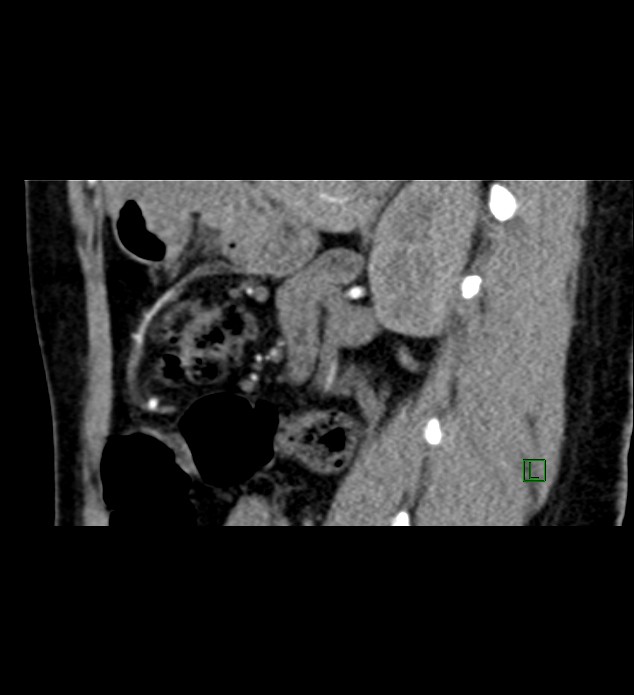 Chromophobe renal cell carcinoma (Radiopaedia 84290-99582 D 37).jpg