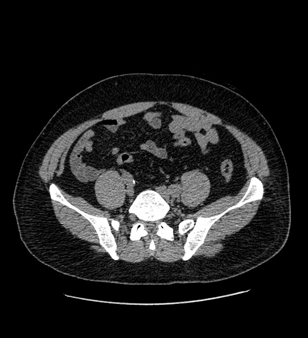 Chromophobe renal cell carcinoma (Radiopaedia 84337-99693 Axial non-contrast 111).jpg
