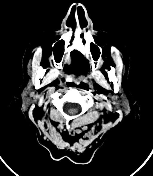 Chronic bilateral subdural hygroma (Radiopaedia 85801-101623 Axial non-contrast 62).jpg