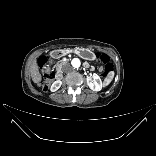 Chronic contained rupture of abdominal aortic aneurysm with extensive erosion of the vertebral bodies (Radiopaedia 55450-61901 A 21).jpg