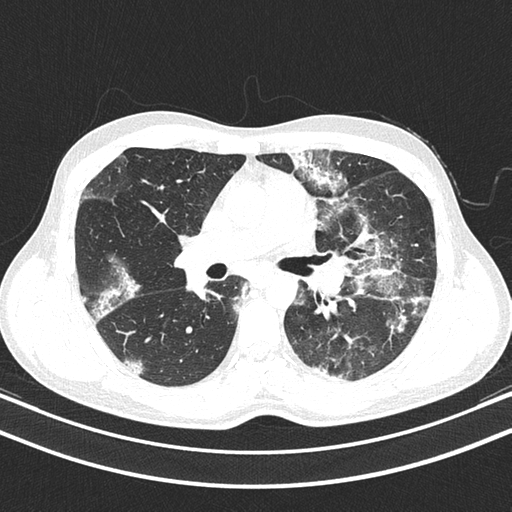 Chronic eosinophilic pneumonia (Radiopaedia 39331-41587 Axial lung window 23).png