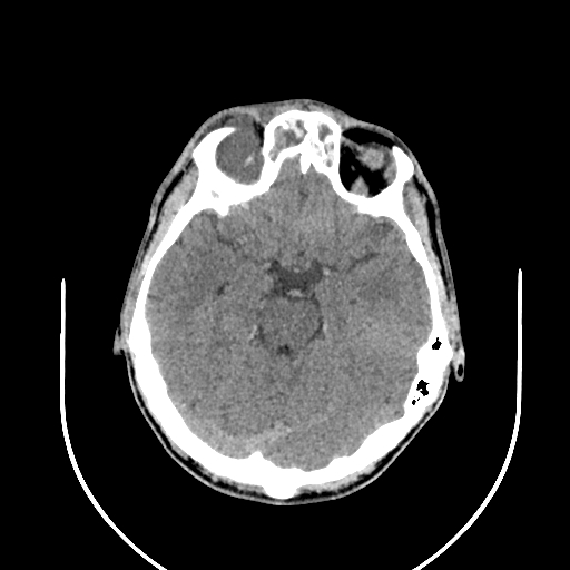 Chronic invasive fungal sinusitis (Radiopaedia 50342-55710 Axial non-contrast 61).jpg
