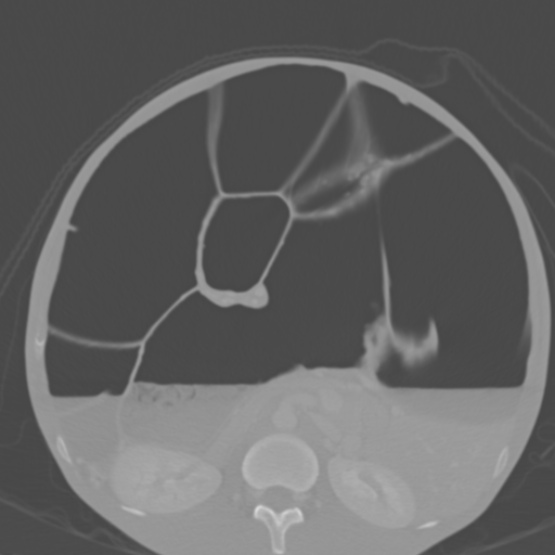 Chronic large bowel pseudo-obstruction (Radiopaedia 43181-46492 Axial bone window 82).jpg