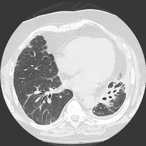Chronic lung allograft dysfunction - restrictive form (Radiopaedia 60595-68316 Axial lung window 43).jpg