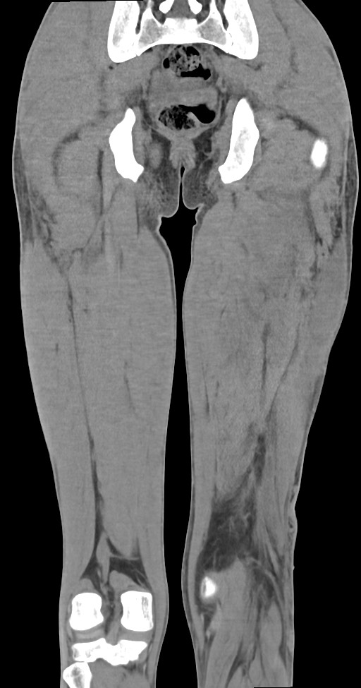 Chronic osteomyelitis (with sequestrum) (Radiopaedia 74813-85822 E 40).jpg