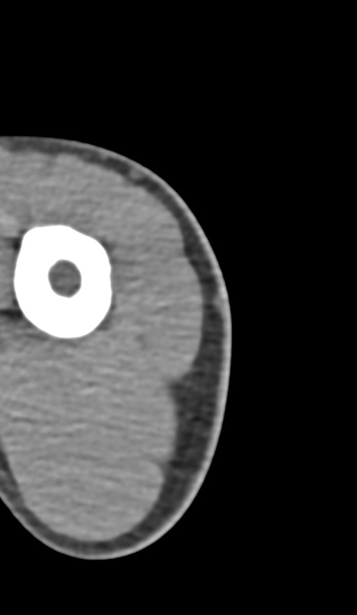 Chronic osteomyelitis of the distal humerus (Radiopaedia 78351-90971 Axial non-contrast 3).jpg
