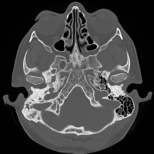 File:Chronic otomastoiditis (Radiopaedia 27138-27309 Axial bone window 17).jpg
