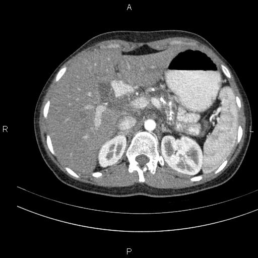 File:Chronic pancreatitis (Radiopaedia 64576-73450 B 35).jpg