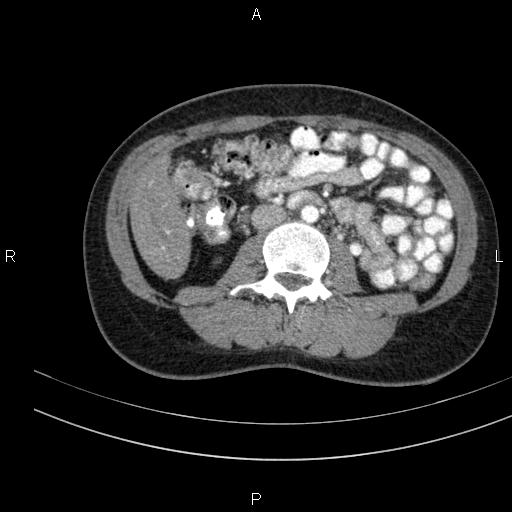 File:Chronic pancreatitis (Radiopaedia 64576-73450 B 84).jpg