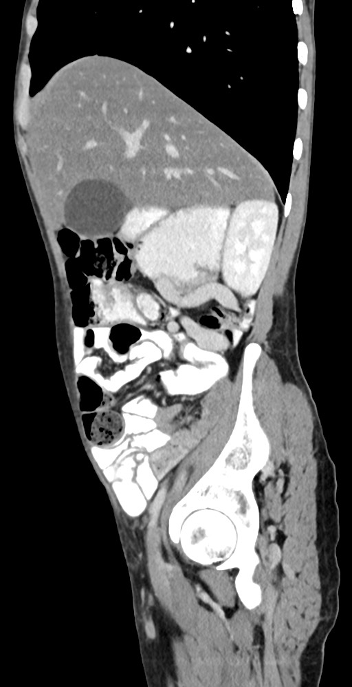 Chronic small bowel volvulus (Radiopaedia 75224-86322 C 106).jpg