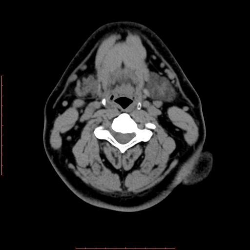 Chronic submandibular sialolithiasis (Radiopaedia 69817-79814 Axial non-contrast 129).jpg