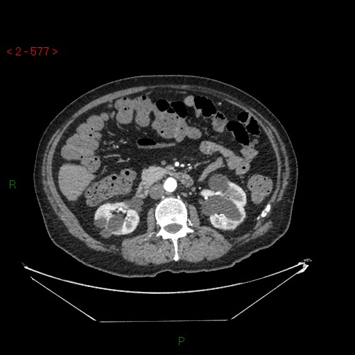 File:Circumaortic left renal vein and doubled left renal arteries (Radiopaedia 52268-58158 A 113).jpg