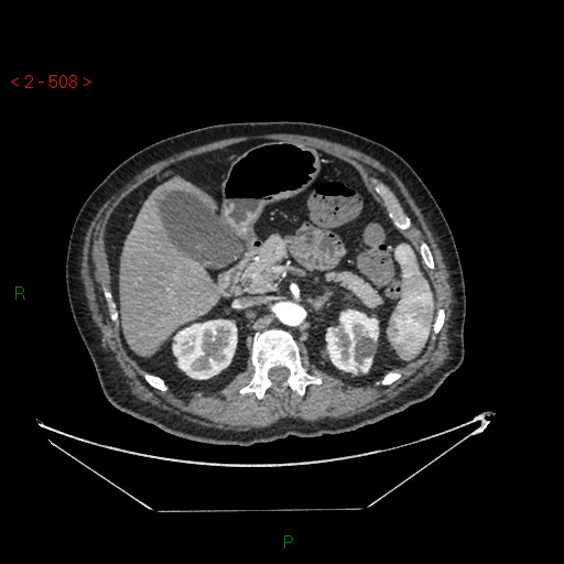 Circumaortic left renal vein and doubled left renal arteries (Radiopaedia 52268-58158 A 44).jpg