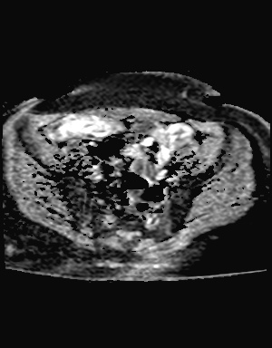File:Class II Mullerian duct anomaly- unicornuate uterus with rudimentary horn and non-communicating cavity (Radiopaedia 39441-41755 Axial ADC 9).jpg