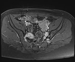 File:Class II Mullerian duct anomaly- unicornuate uterus with rudimentary horn and non-communicating cavity (Radiopaedia 39441-41755 Axial T1 fat sat 43).jpg