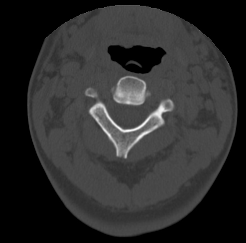 Clay-shoveler fracture (Radiopaedia 22568-22590 Axial bone window 21).jpg
