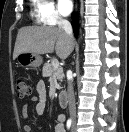 File:Clear cell renal cell carcinoma (Radiopaedia 61449-69393 D 60).jpg