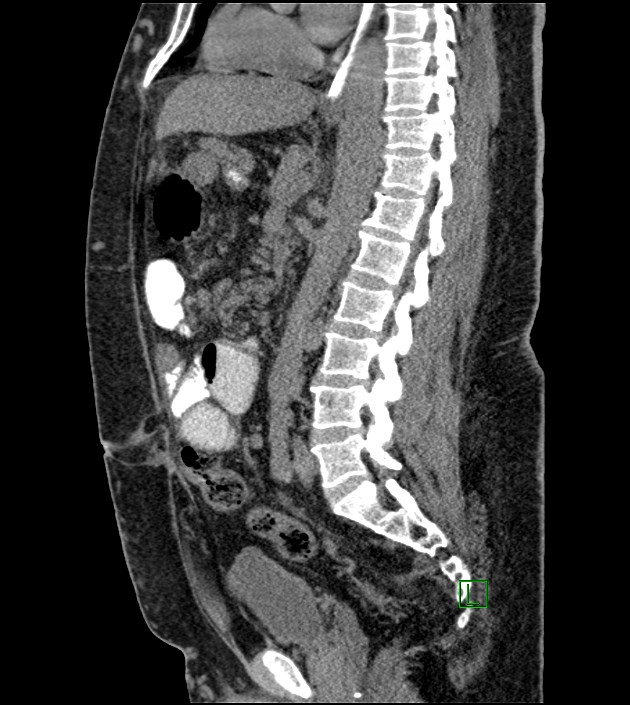 Closed-loop small bowel obstruction-internal hernia (Radiopaedia 78439-91096 C 73).jpg