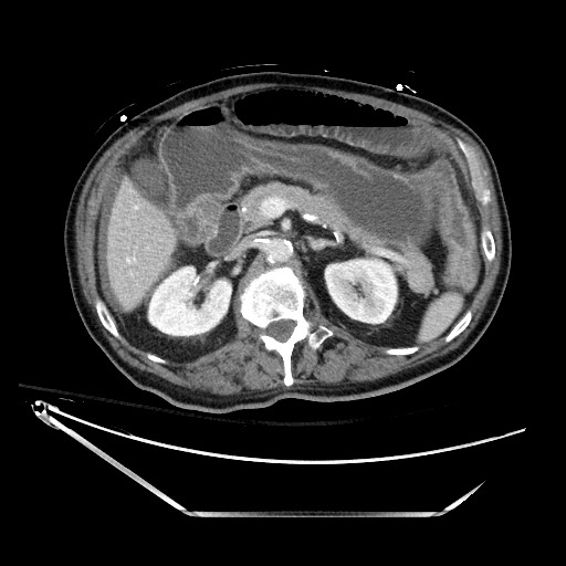 File:Closed loop obstruction due to adhesive band, resulting in small bowel ischemia and resection (Radiopaedia 83835-99023 D 56).jpg