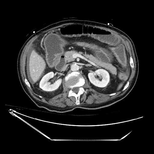 Closed loop obstruction due to adhesive band, resulting in small bowel ischemia and resection (Radiopaedia 83835-99023 D 59).jpg