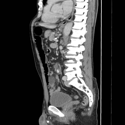 Closed loop small bowel obstruction (Radiopaedia 59227-66554 C 37).jpg