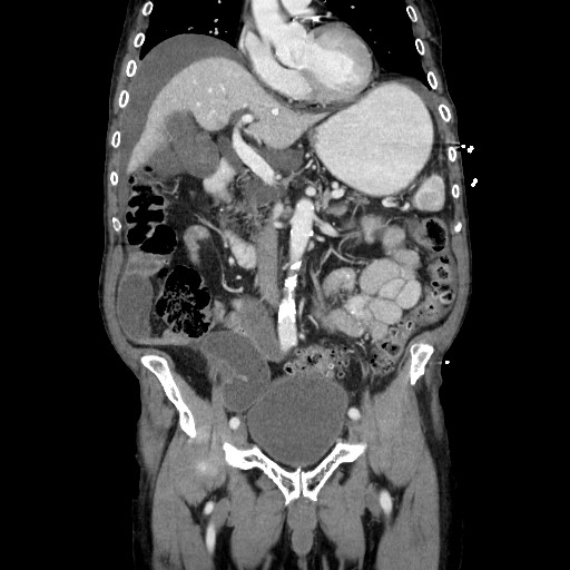 Closed loop small bowel obstruction - adhesive disease and hemorrhagic ischemia (Radiopaedia 86831-102990 B 60).jpg