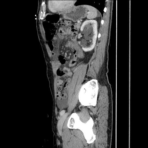 File:Closed loop small bowel obstruction - omental adhesion causing "internal hernia" (Radiopaedia 85129-100682 C 125).jpg