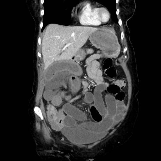 Closed loop small bowel obstruction due to adhesive band, with intramural hemorrhage and ischemia (Radiopaedia 83831-99017 C 39).jpg