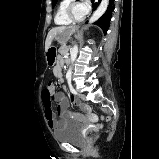 Closed loop small bowel obstruction due to adhesive band, with intramural hemorrhage and ischemia (Radiopaedia 83831-99017 D 115).jpg