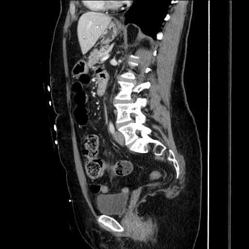 Closed loop small bowel obstruction due to adhesive bands - early and late images (Radiopaedia 83830-99014 C 104).jpg